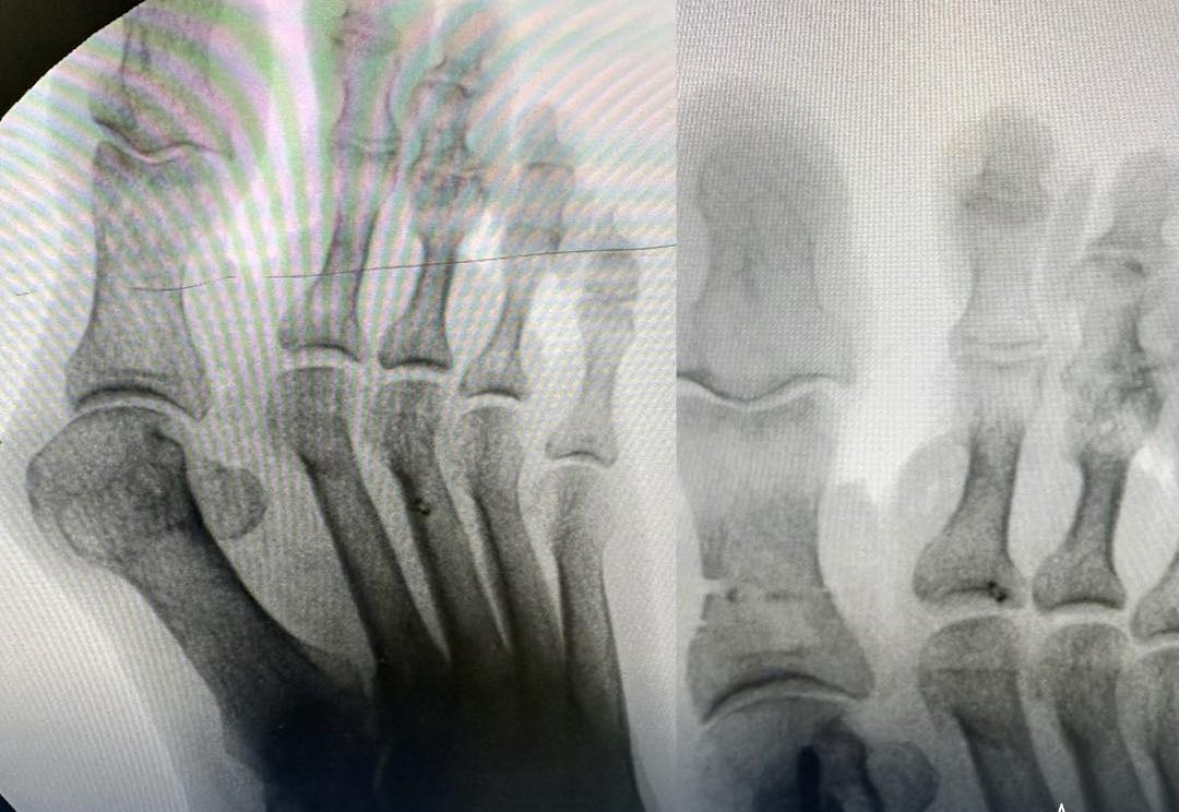 В Атырау налажен бесплатный и современный метод лечения деформации стоп костей