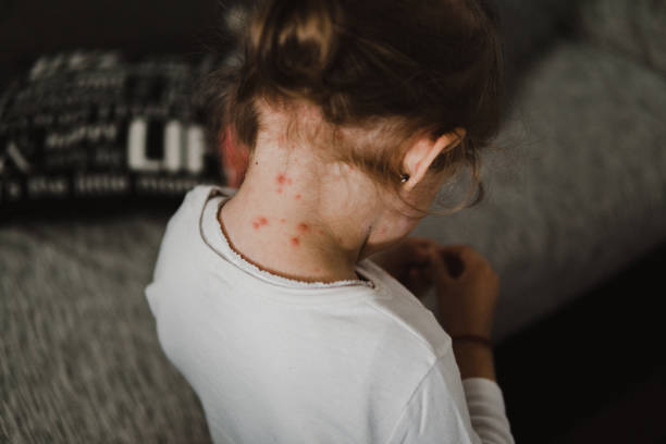 В Атырауской области зарегистрировано 304 случая кори